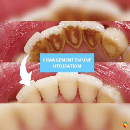 Appareil de nettoyage des dents